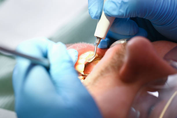 Best Emergency Tooth Extraction in Kenmore, NY